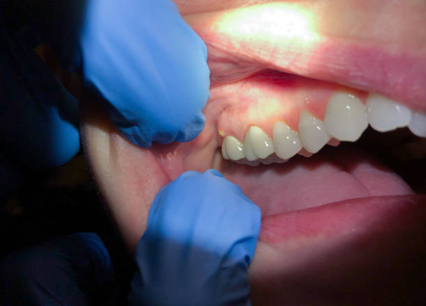 Best Emergency Tooth Extraction in Medfd, OR